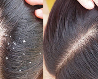 Comparison of two images side by side: On the left, a woman's scalp and hair with visible dandruff. On the right, the same woman's scalp and hair without any visible dandruff.