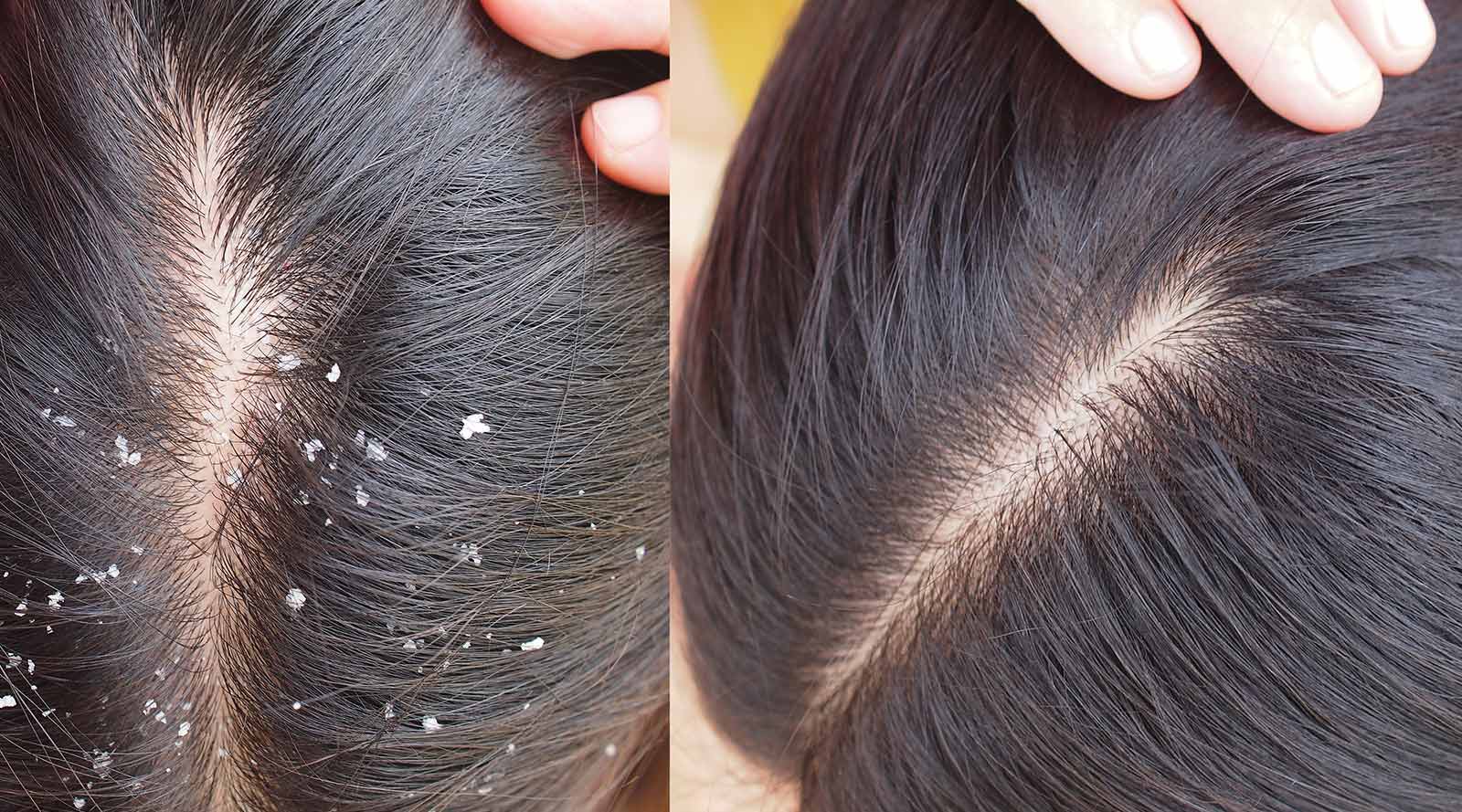 Comparison of two images side by side: On the left, a woman's scalp and hair with visible dandruff. On the right, the same woman's scalp and hair without any visible dandruff.